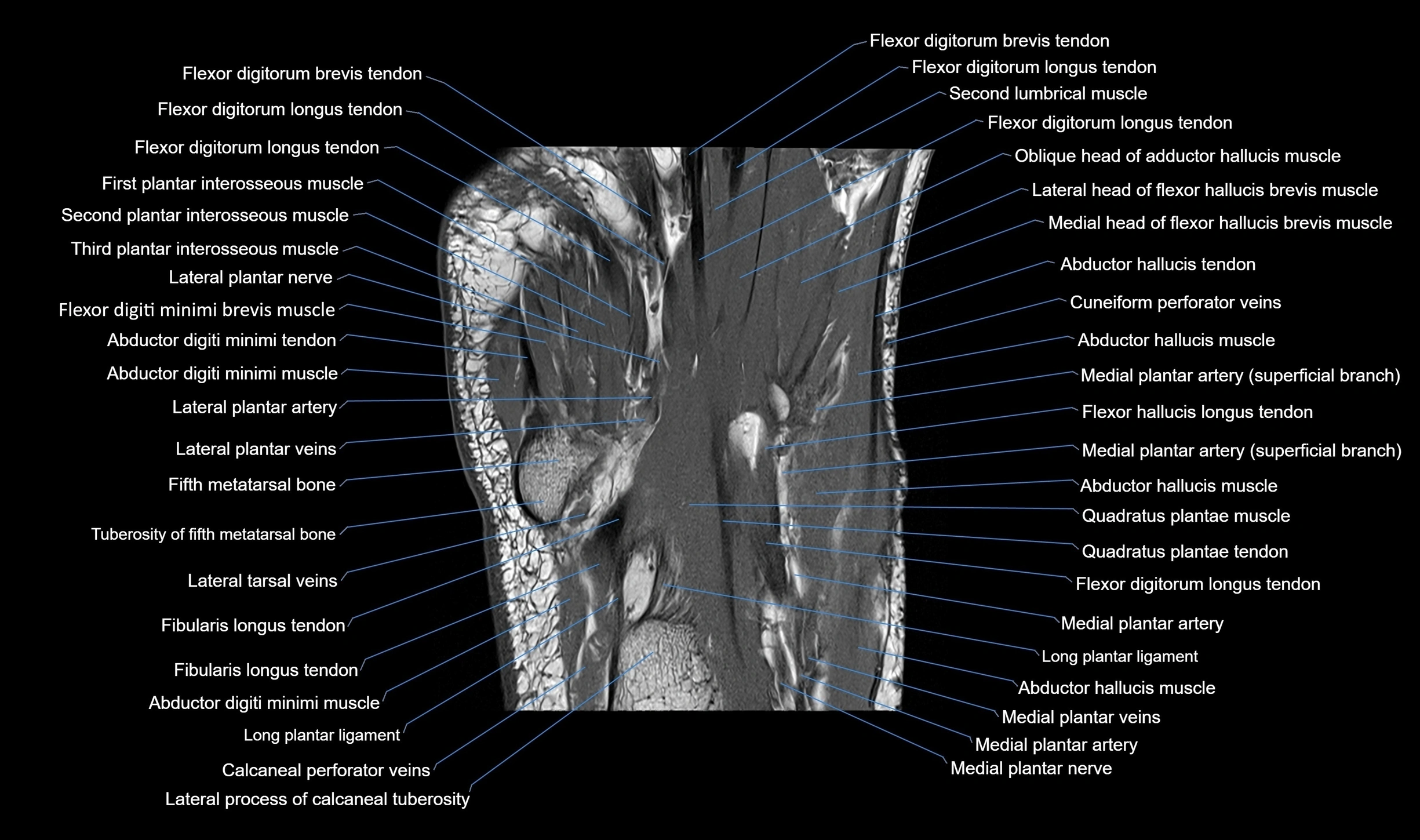 MRI mid foot coronal ligaments cross sectional anatomy 3T  radiology  image-img-00001-00030.webp